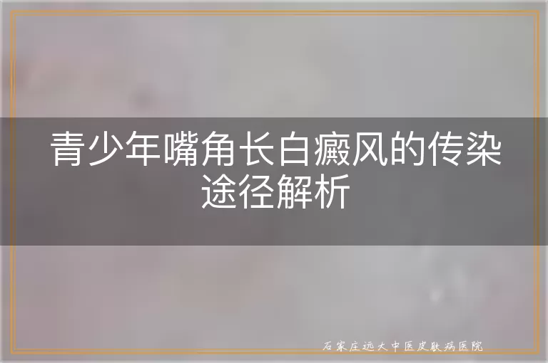 青少年嘴角长白癜风的传染途径解析