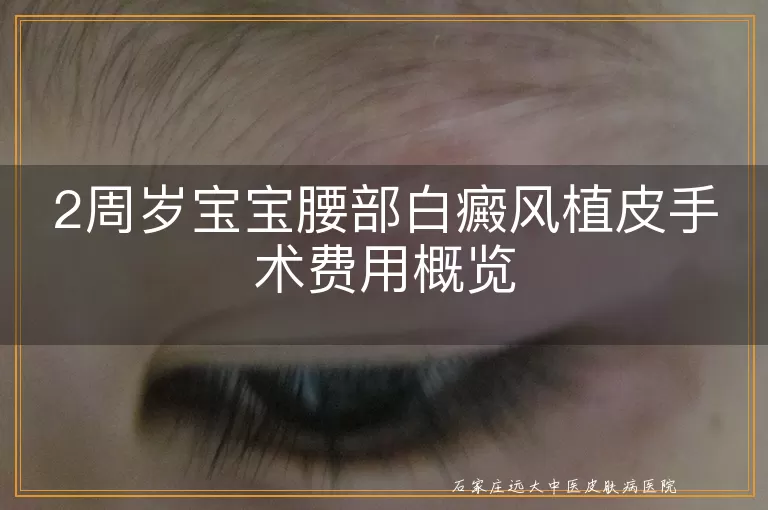 2周岁宝宝腰部白癜风植皮手术费用概览