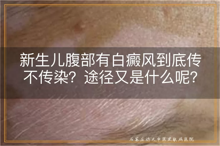 新生儿腹部有白癜风到底传不传染?途径又是什么呢?