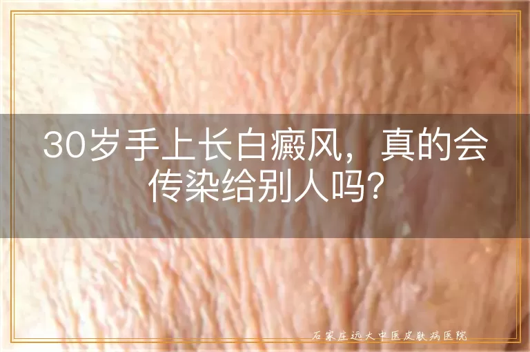 30岁手上长白癜风，真的会传染给别人吗？