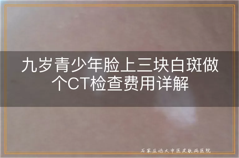 九岁青少年脸上三块白斑做个CT检查费用详解