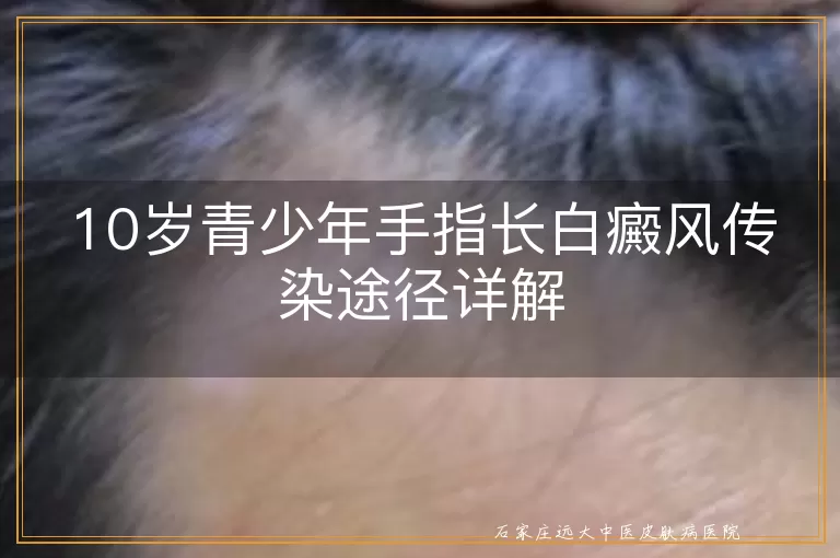 10岁青少年手指长白癜风传染途径详解