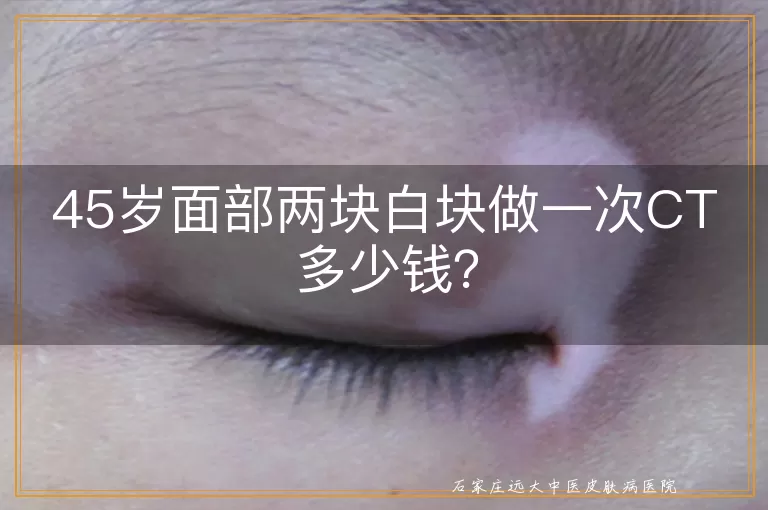 45岁面部两块白块做一次CT多少钱？