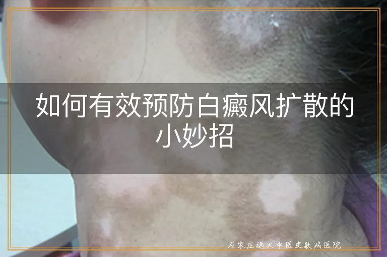 如何有效预防白癜风扩散的小妙招