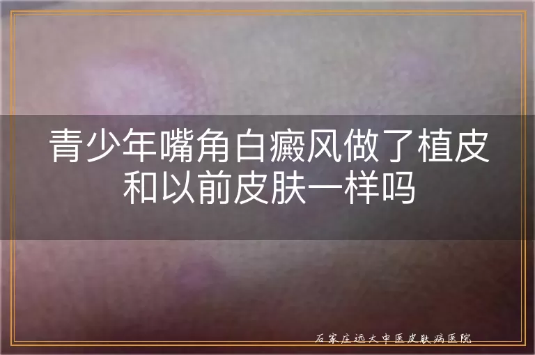青少年嘴角白癜风做了植皮和以前皮肤一样吗