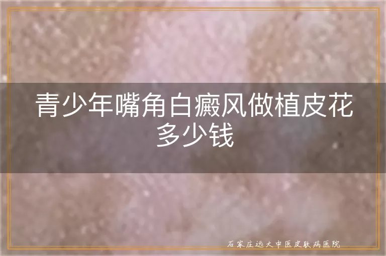 青少年嘴角白癜风做植皮花多少钱