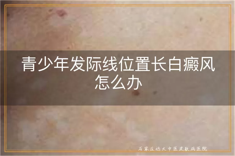 青少年发际线位置长白癜风怎么办