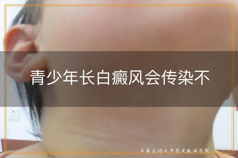 青少年长白癜风会传染不