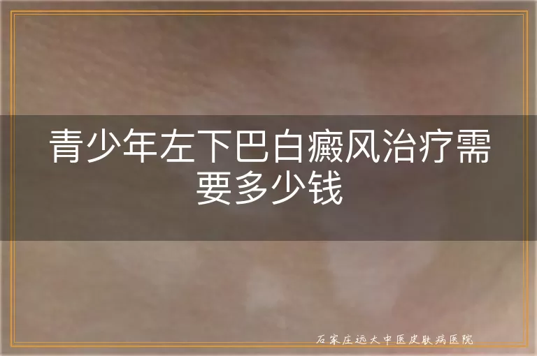青少年左下巴白癜风治疗需要多少钱