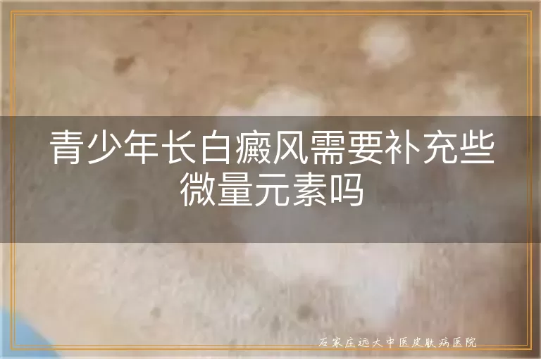 青少年长白癜风需要补充些微量元素吗