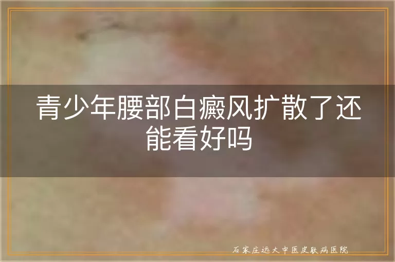 青少年腰部白癜风扩散了还能看好吗