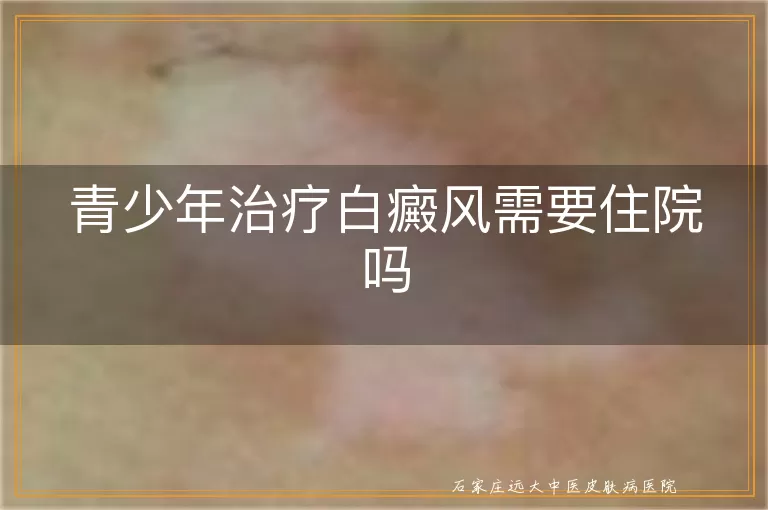 青少年治疗白癜风需要住院吗