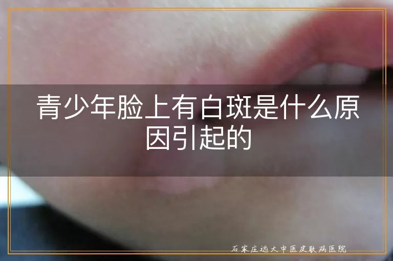 青少年脸上有白斑是什么原因引起的