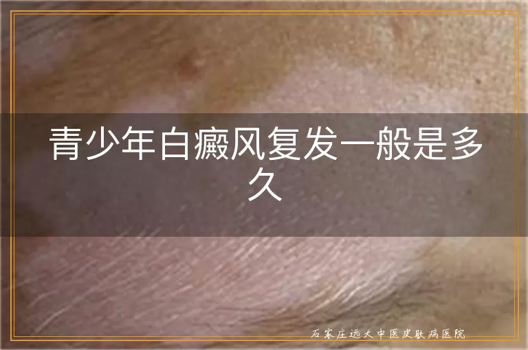 青少年白癜风复发一般是多久