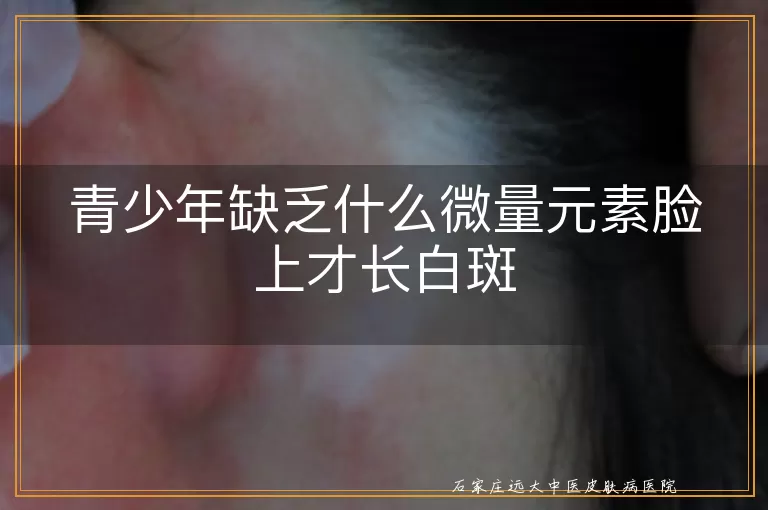 青少年缺乏什么微量元素脸上才长白斑