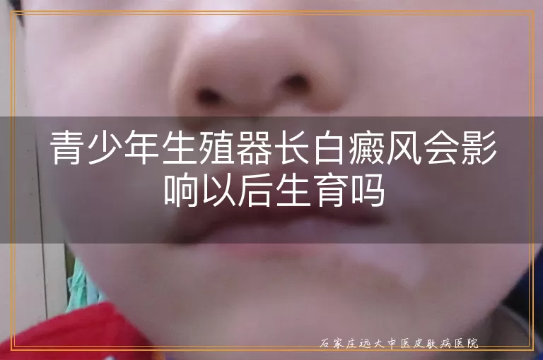 青少年生殖器长白癜风会影响以后生育吗