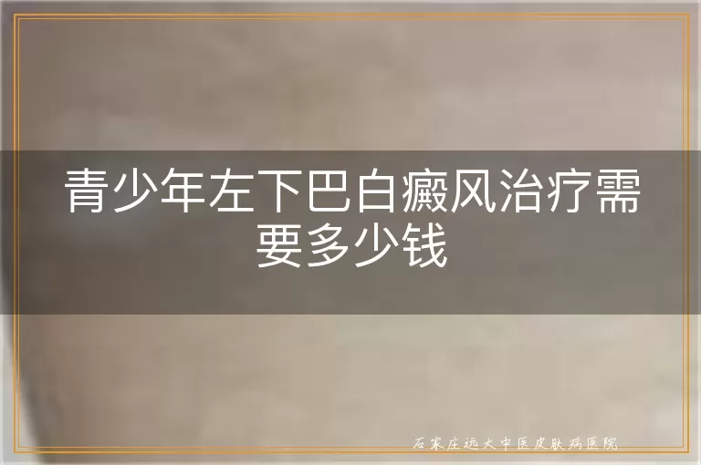 青少年左下巴白癜风治疗需要多少钱