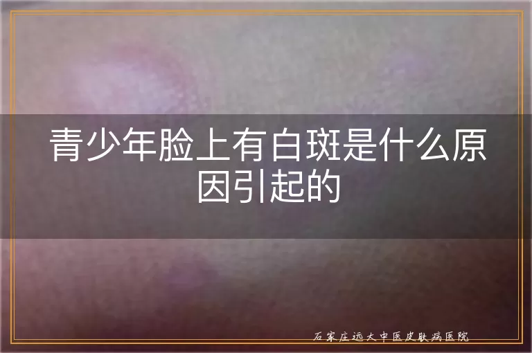 青少年脸上有白斑是什么原因引起的