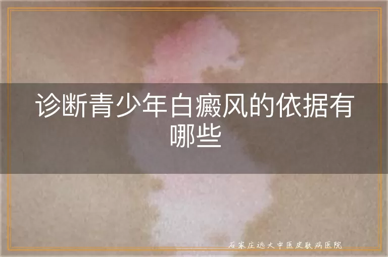 诊断青少年白癜风的依据有哪些