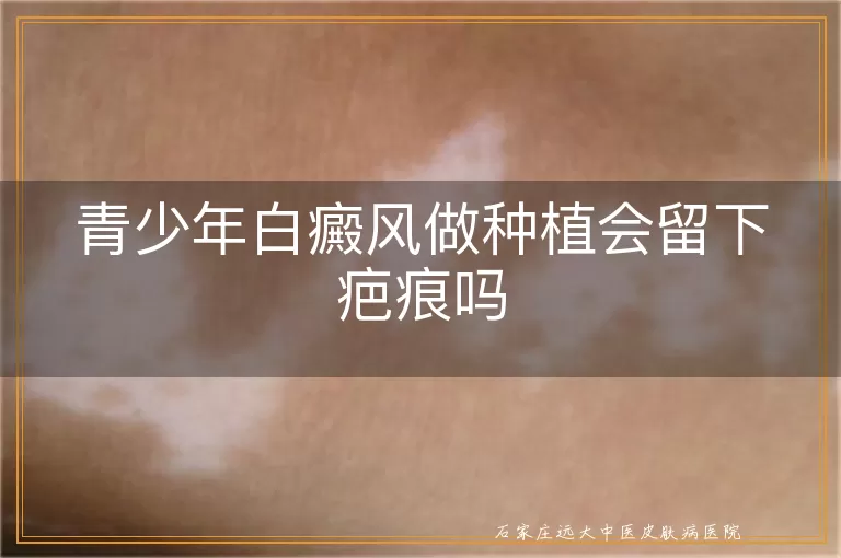 青少年白癜风做种植会留下疤痕吗