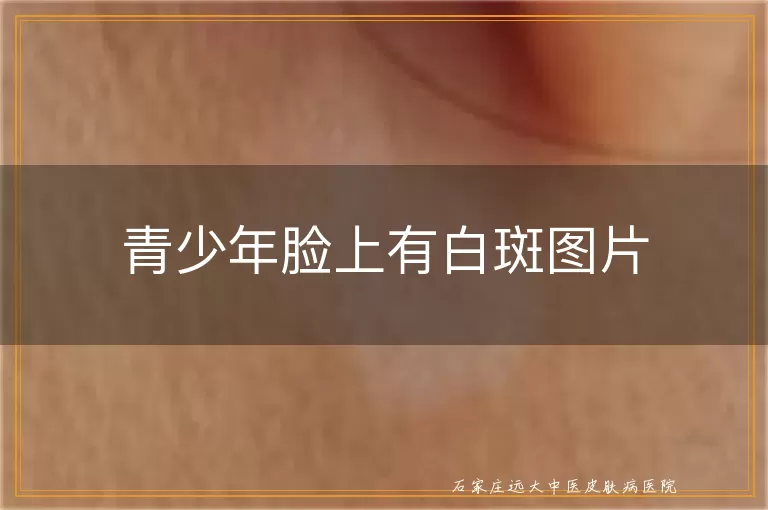 青少年脸上有白斑图片