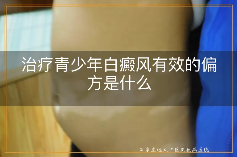 治疗青少年白癜风有效的偏方是什么