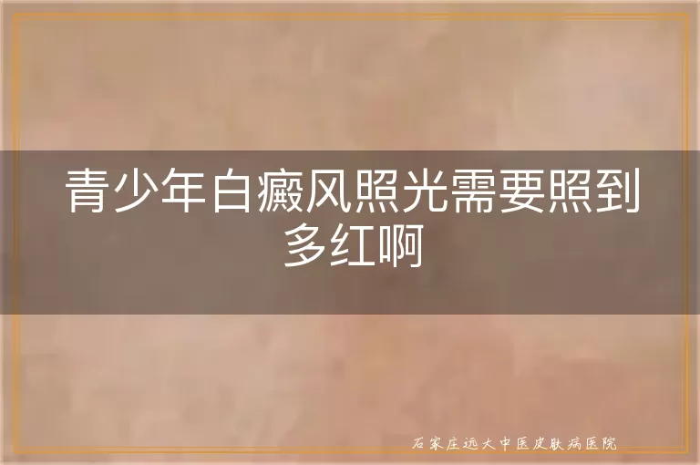 青少年白癜风照光需要照到多红啊