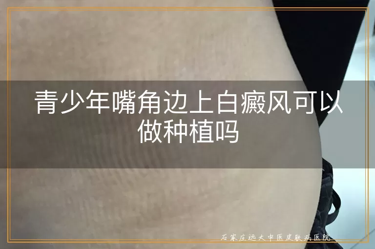 青少年嘴角边上白癜风可以做种植吗