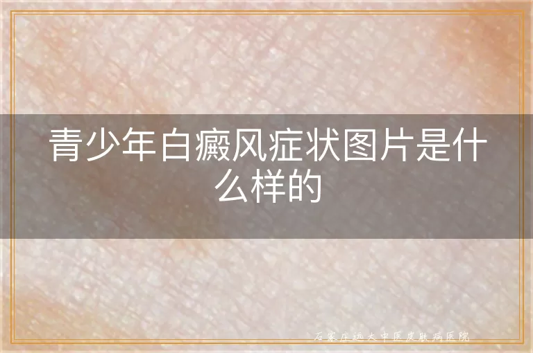 青少年白癜风症状图片是什么样的