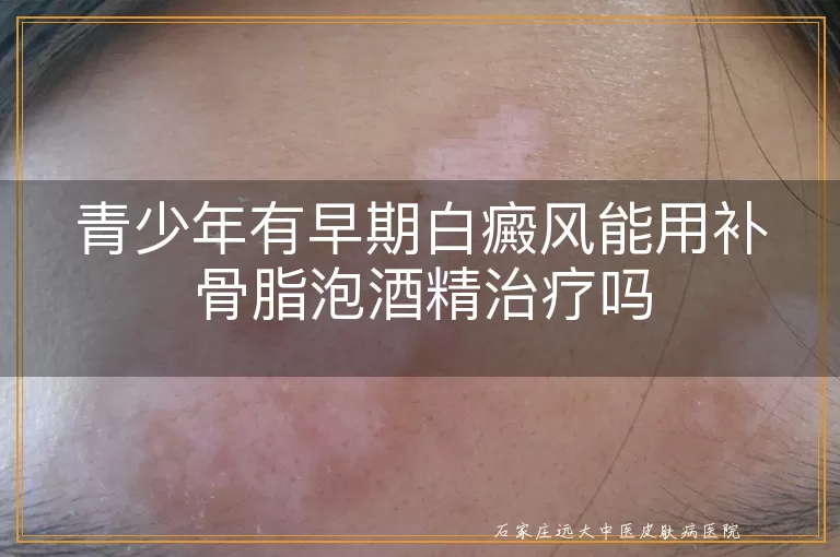 青少年有早期白癜风能用补骨脂泡酒精治疗吗