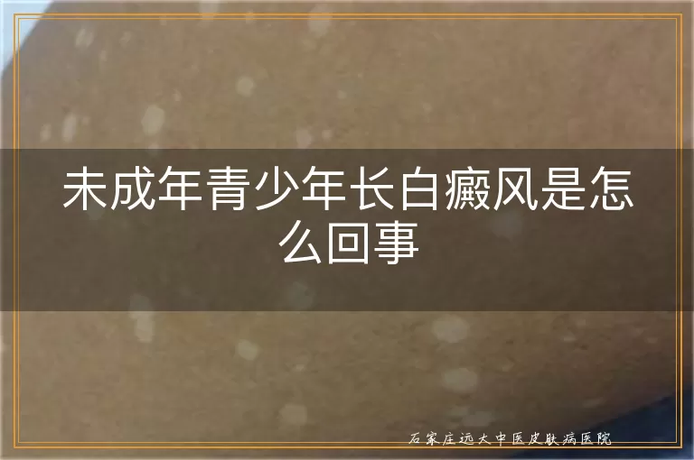 未成年青少年长白癜风是怎么回事