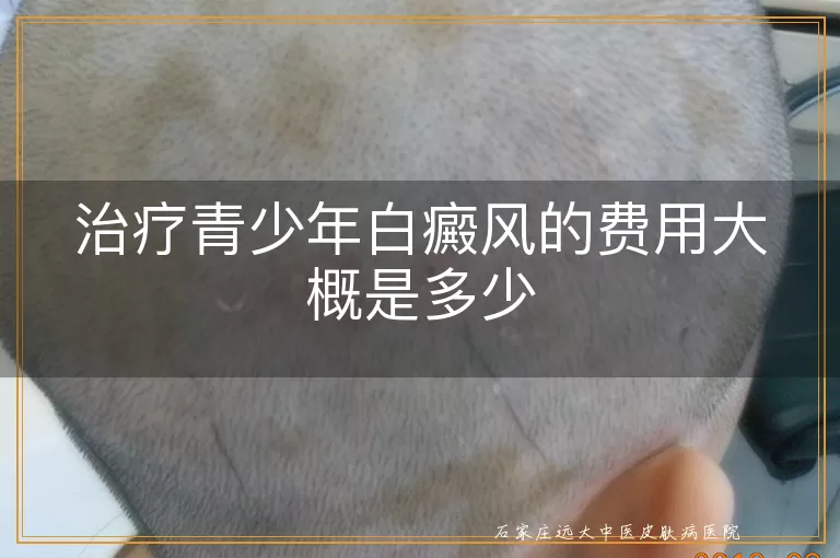 治疗青少年白癜风的费用大概是多少