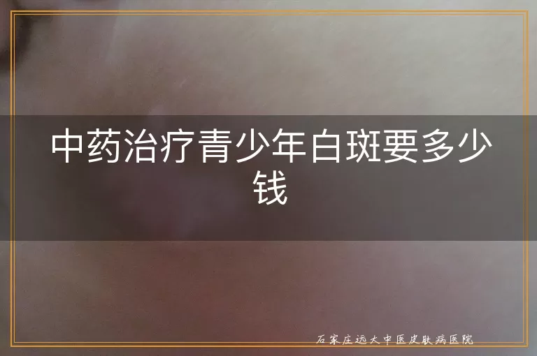 中药治疗青少年白斑要多少钱