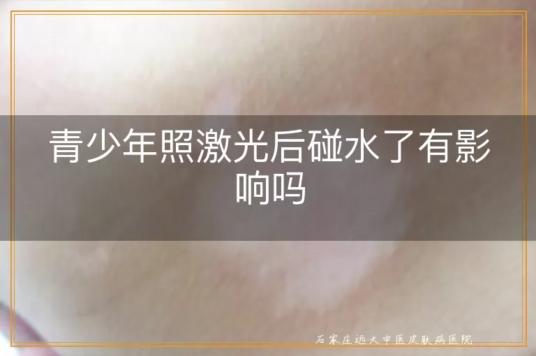 青少年照激光后碰水了有影响吗