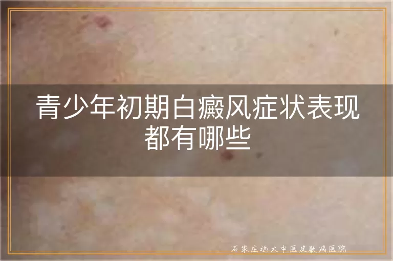 青少年初期白癜风症状表现都有哪些