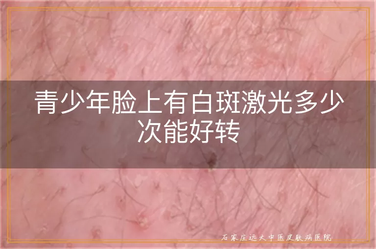 青少年脸上有白斑激光多少次能好转
