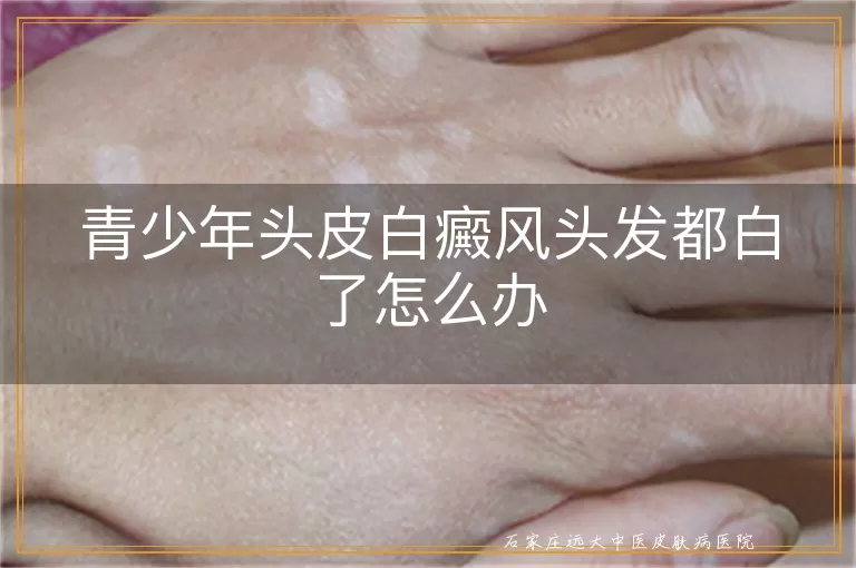 青少年头皮白癜风头发都白了怎么办