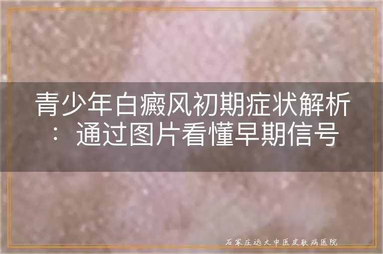 青少年白癜风初期症状解析：通过图片看懂早期信号