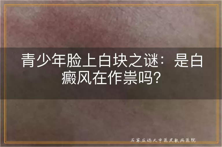青少年脸上白块之谜：是白癜风在作祟吗？