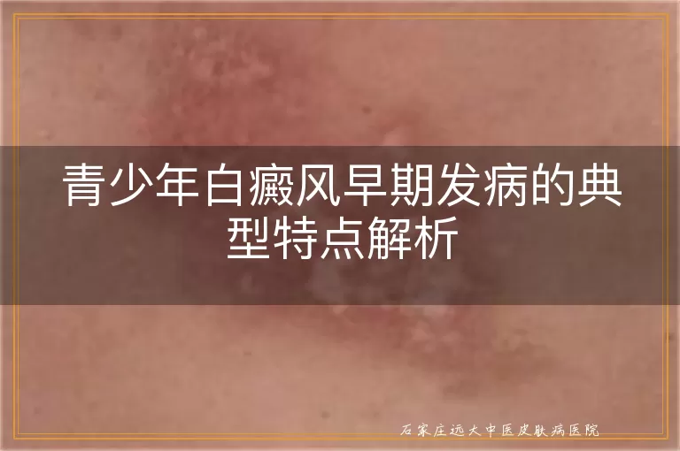 青少年白癜风早期发病的典型特点解析