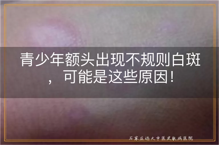青少年额头出现不规则白斑，可能是这些原因！