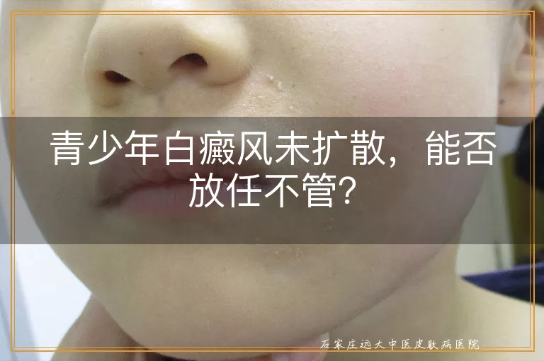 青少年白癜风未扩散，能否放任不管？