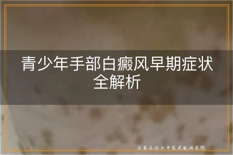 青少年手部白癜风早期症状全解析