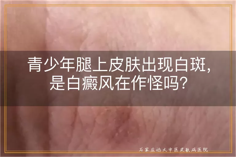 青少年腿上皮肤出现白斑，是白癜风在作怪吗？