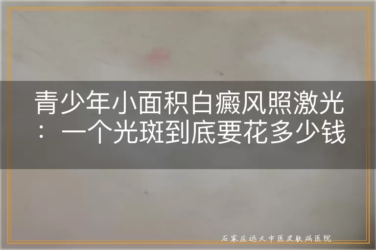 青少年小面积白癜风照激光：一个光斑到底要花多少钱？