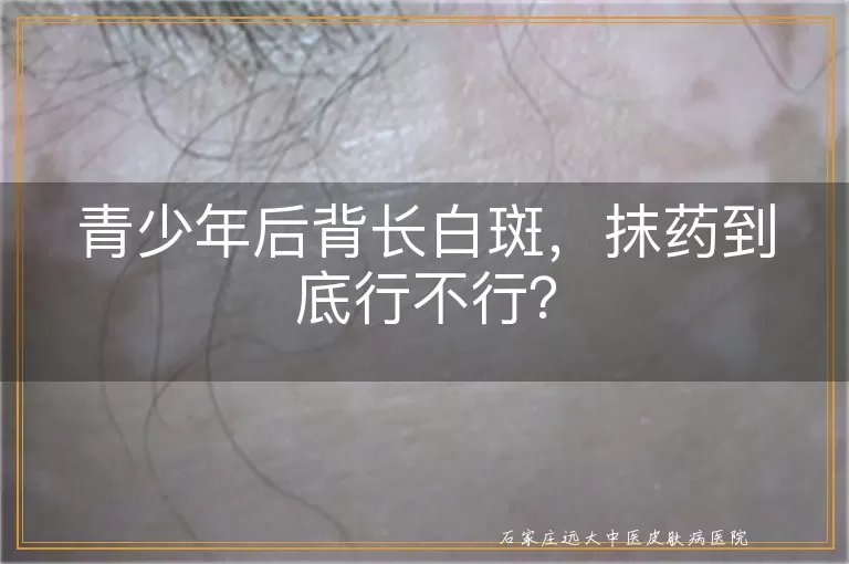 青少年后背长白斑，抹药到底行不行？