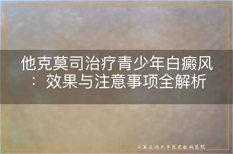 他克莫司治疗青少年白癜风：效果与注意事项全解析