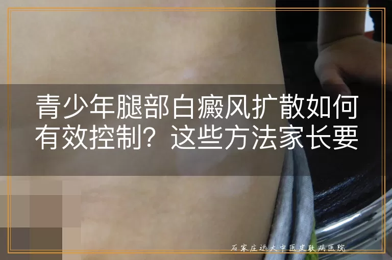 青少年腿部白癜风扩散如何有效控制？这些方法家长要了解！