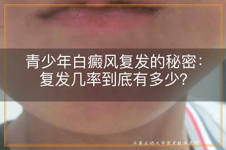 青少年白癜风复发的秘密：复发几率到底有多少？