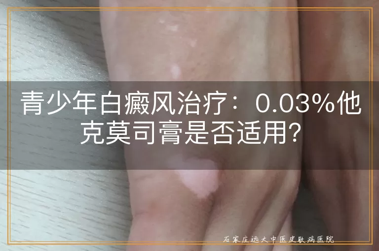 青少年白癜风治疗：0.03%他克莫司膏是否适用？